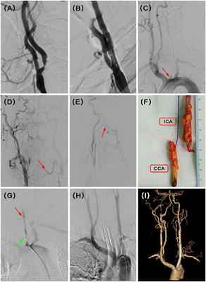 Hybrid Recanalization for the Treatment of Carotid/Vertebral In-stent Restenosis or Occlusion: Pilot Surgery Experiences From One Single Center